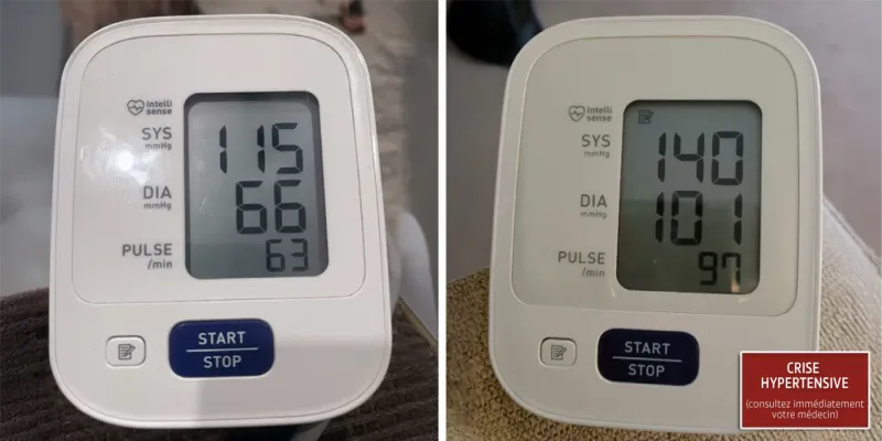Crise hypertensive liée à l'apnée du sommeil
